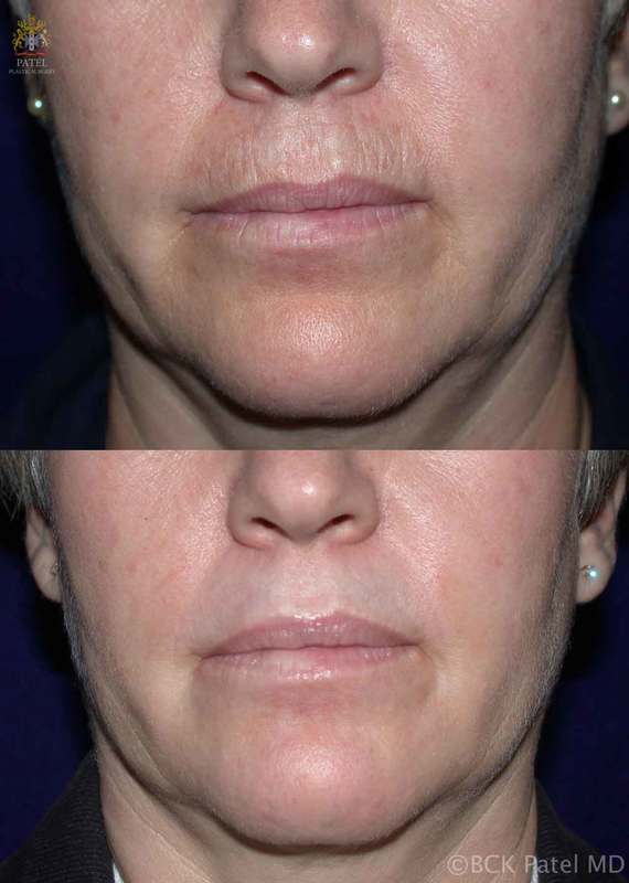 Lip Lines Patel Plastic Surgery